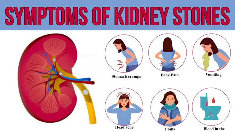 Symptoms of kidney stone